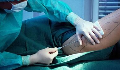 Chirurgie pentru pierderea în greutate